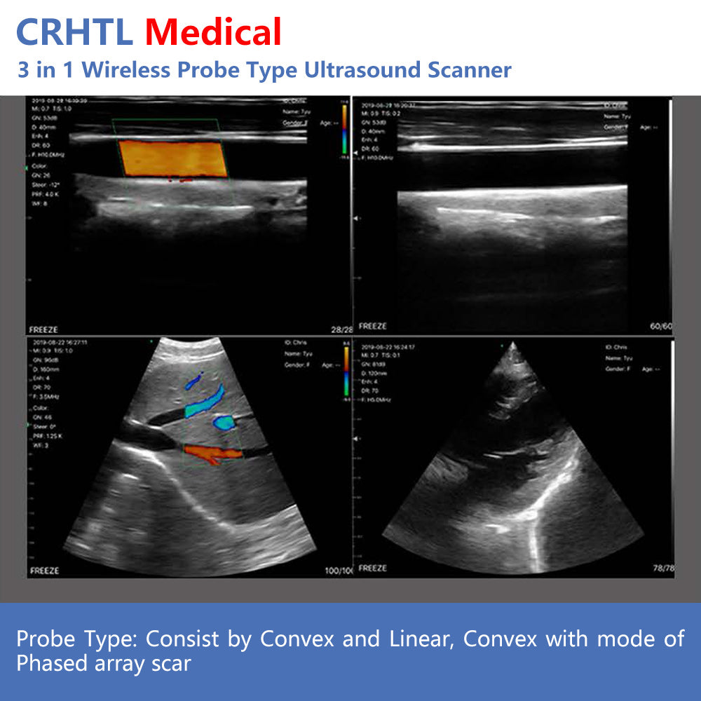 Ultrasonido portátil 3 en 1 con sonda inalámbrica y wifi, compatible con iOS, Android y Windows.